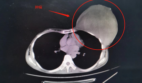 一年时间肿瘤狂长5公斤，茂医专家提醒女性要注意！