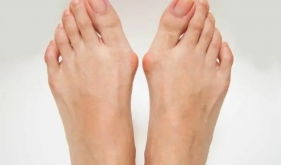 茂医专家说丨注意啦！“拇外翻”为女性高发